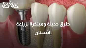 وداعًا للجراحة التقليدية: حلول مبتكرة وحديثة في زراعة الأسنان